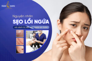 sẹo lồi ngứa