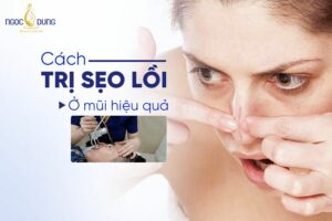 Sẹo lồi ở mũi