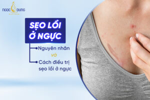 sẹo lồi ở ngực