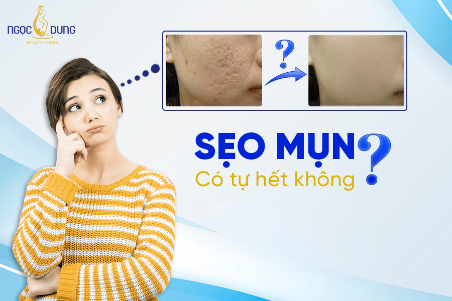 Sẹo mụn có tự hết không? Các phương pháp điều trị hiệu quả 