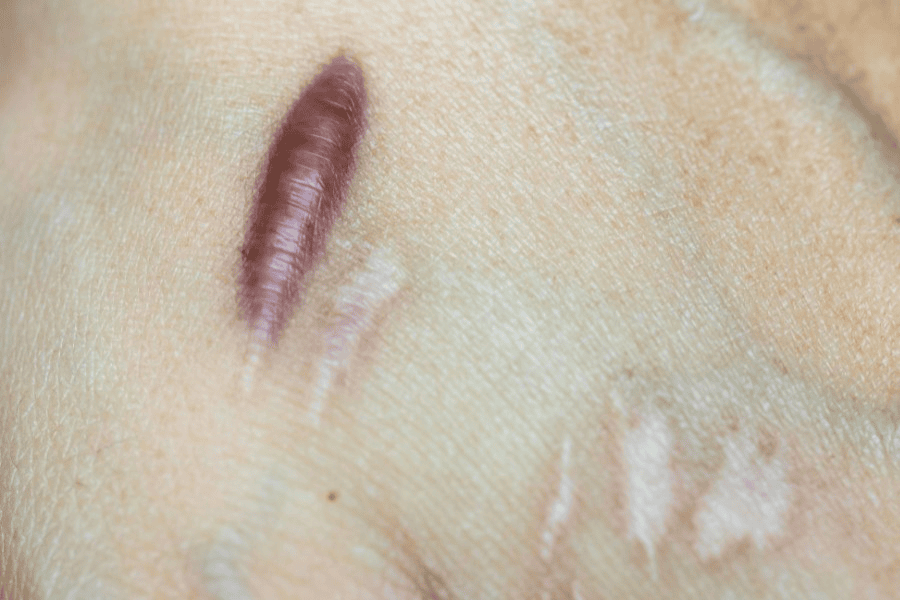 Cách điều trị sẹo phì đại an toàn, hiệu quả và thẩm mỹ 5 Sẹo phì đại hiện rõ trên da và có màu sắc khác biệt, ảnh hưởng lớn tới thẩm mỹ