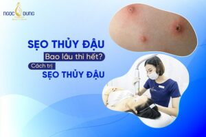 Sẹo thủy đậu