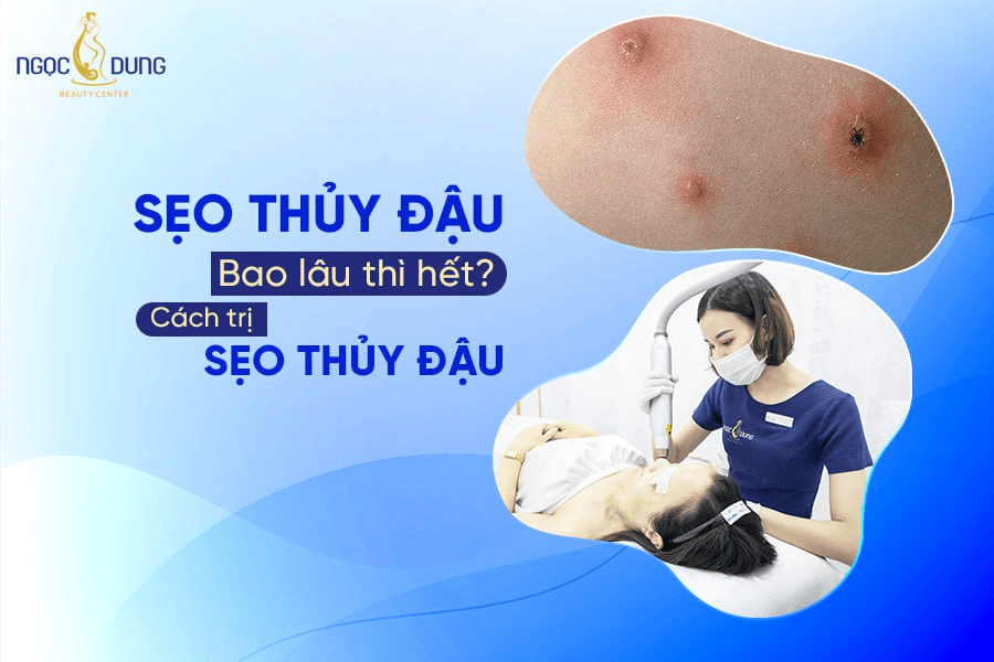 Sẹo thủy đậu bao lâu thì hết? Có cần can thiệp bằng công nghệ cao không?