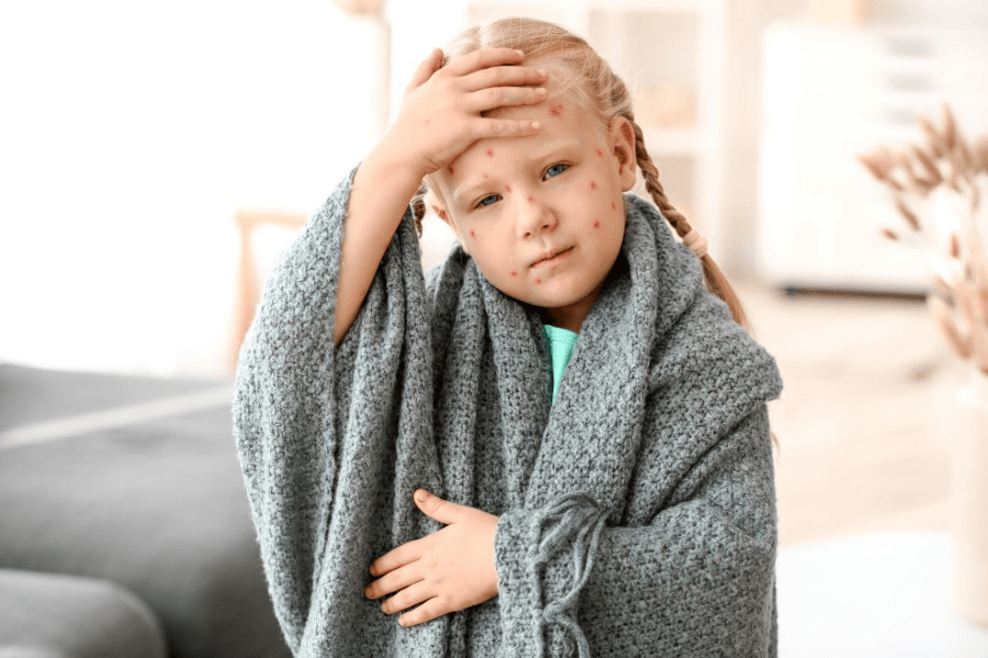 Sẹo thủy đậu mờ dần theo thời gian và phụ thuộc vào tình trạng và độ tuổi 