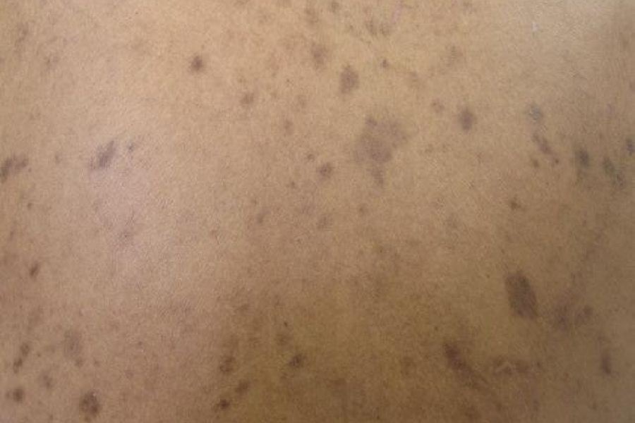 Tăng sắc tố sau viêm gây ảnh hưởng đến thẩm mỹ diện mạo và thường khó điều trị dứt điểm