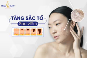 Tăng sắc tố sau viêm có điều trị được không?