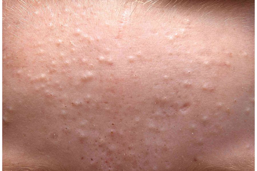 Mụn ẩn là một trong số các loại mụn trên da thường gặp