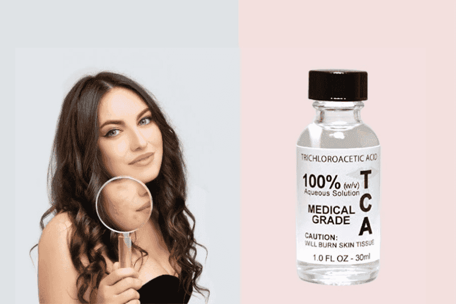 TCA Cross là kỹ thuật dùng Trichloroacetic Acid chấm trực tiếp vào đáy từng vết sẹo rỗ