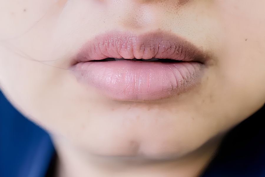 Viền môi sẫm rõ hơn lòng môi là một biểu hiện thường gặp ở người có sắc tố môi không đồng đều