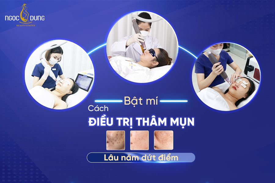 Tổng hợp các cách trị vết thâm mụn lâu năm có thể bạn quan tâm Tổng hợp các cách trị vết thâm mụn lâu năm có thể bạn quan tâm