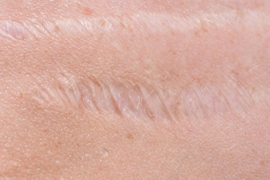 Tiêm sẹo lồi giúp kích thích sản xuất collagen tái tạo da từ bên trong