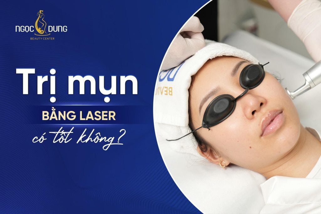Trị mụn bằng laser mang lại những hiệu quả gì?