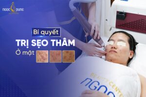 Trị sẹo thâm ở mặt