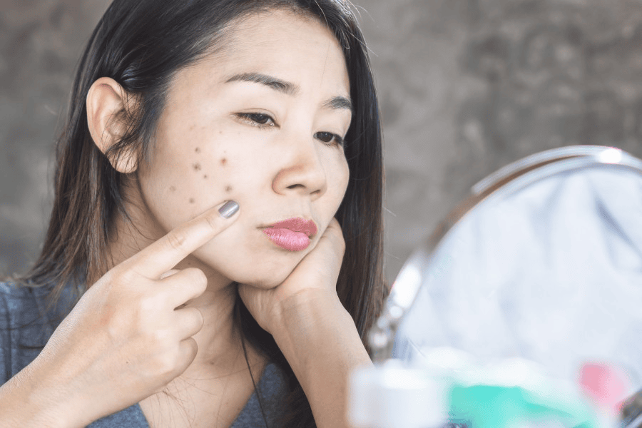 Vết thâm sau viêm có thể phục hồi dựa trên chu kỳ tái tạo da