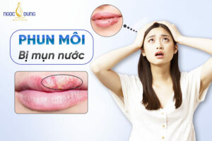 Vì sao phun môi bị mụn nước? Bôi thuốc gì? Bao lâu thì khỏi?