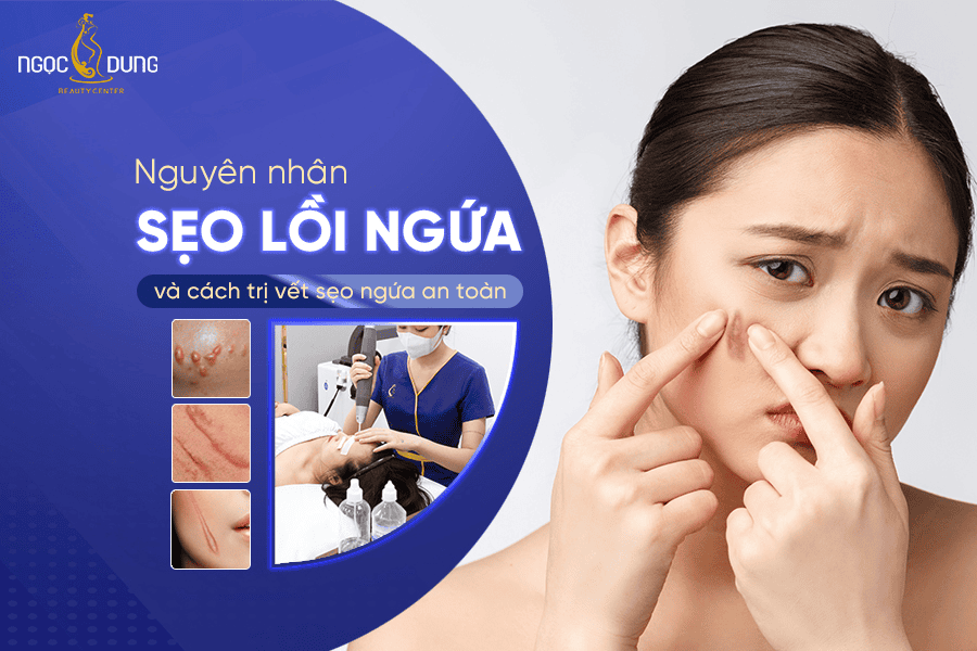 Nguyên nhân sẹo lồi ngứa và cách điều trị hiệu quả