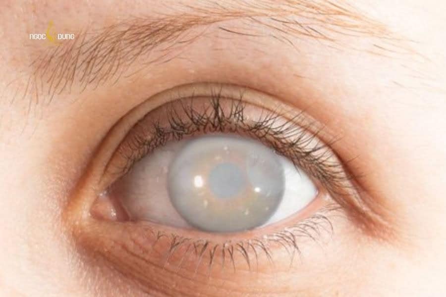 Xóa xăm mí mắt có nguy hiểm không? Những lưu ý cần biết 6 Xăm mí mắt không đúng kỹ thuật có thể gây ra biến chứng mù lòa