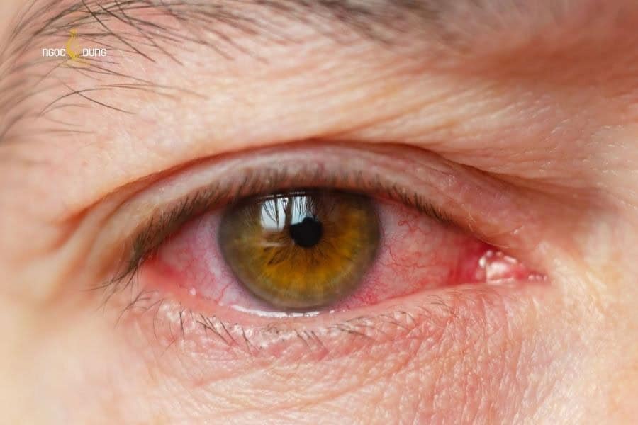 Xóa xăm mí mắt có nguy hiểm không? Những lưu ý cần biết 5 Không đảm bảo vệ sinh khi xăm mí có thể làm nhiễm trùng vùng mắt
