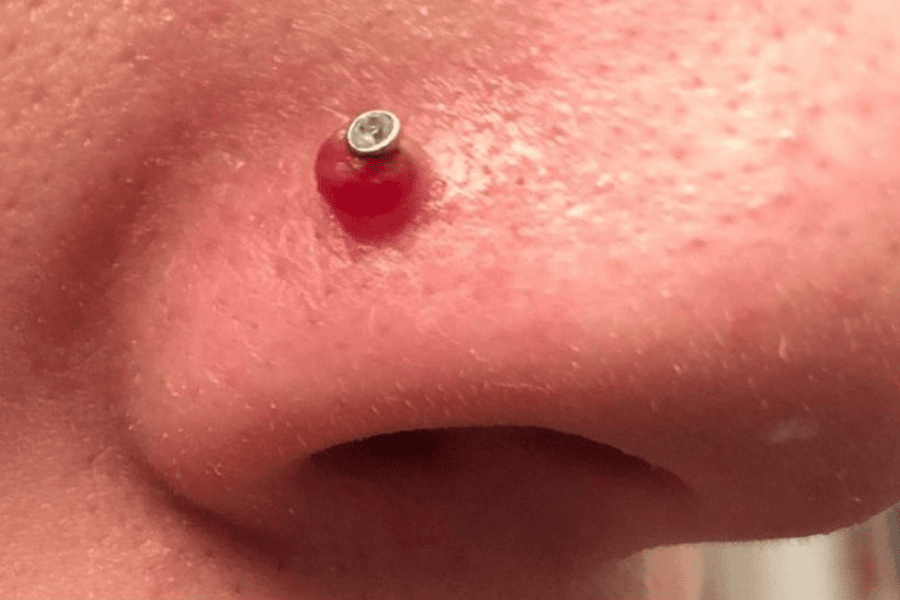 Xỏ khuyên mũi là nguyên nhân hàng đầu gây sẹo lồi vùng này vì tạo vết thương xuyên mô da