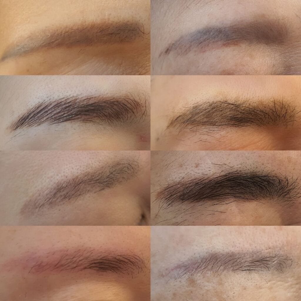 Xoá xăm chân mày là giải pháp khắc phục chân mày bị loang màu, bị lệch dáng hoặc muốn đổi dáng màu hiện đại hơn