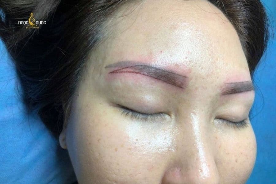 Xóa xăm chân mày có để lại sẹo không? Lợi ích và rủi ro 4 Nên xóa xăm chân mày nếu dáng mày đang bị mất thẩm mỹ