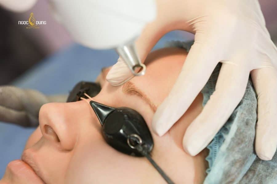 Xóa xăm chân mày có để lại sẹo không? Lợi ích và rủi ro 8 Xóa vết xăm chân mày không gây nguy hiểm nếu dùng công nghệ đạt chuẩn