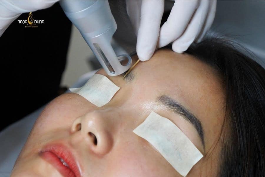 Xóa xăm chân mày có để lại sẹo không? Lợi ích và rủi ro 3 Công nghệ Laser thường được đánh giá cao trong xóa xăm chân mày vì mang lại kết quả lâu dài và an toàn cho da
