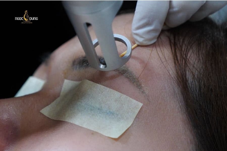 Xóa xăm chân mày có để lại sẹo không? Lợi ích và rủi ro 5 Xóa xăm mày bằng laser là lựa chọn an toàn nhất hiện nay