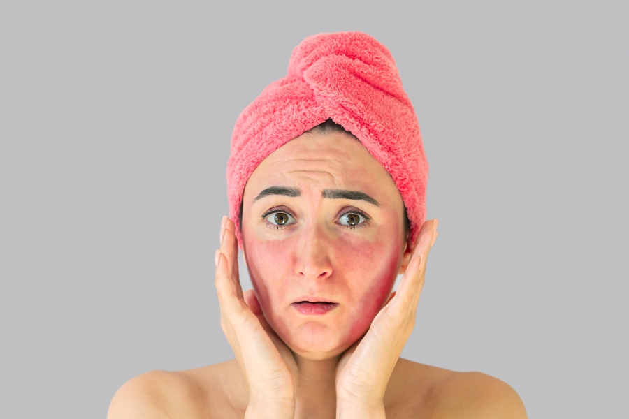 Tiêm meso trị mụn có thể tăng độ nhạy cảm của da khi ra nắng