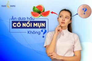 Giải đáp từ chuyên gia: Ăn dưa hấu có nổi mụn không?