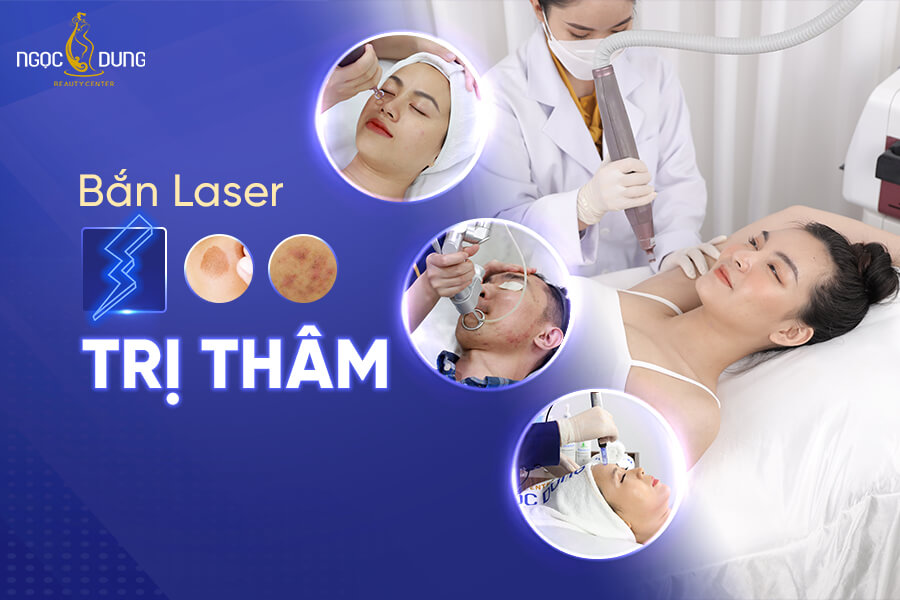 Bắn laser trị thâm áp dụng được trên vùng da nào?