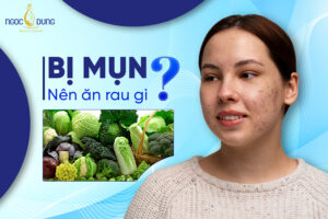 Bị mụn nên ăn rau gì? Top 8 loại rau củ nên ăn khi bị mụn