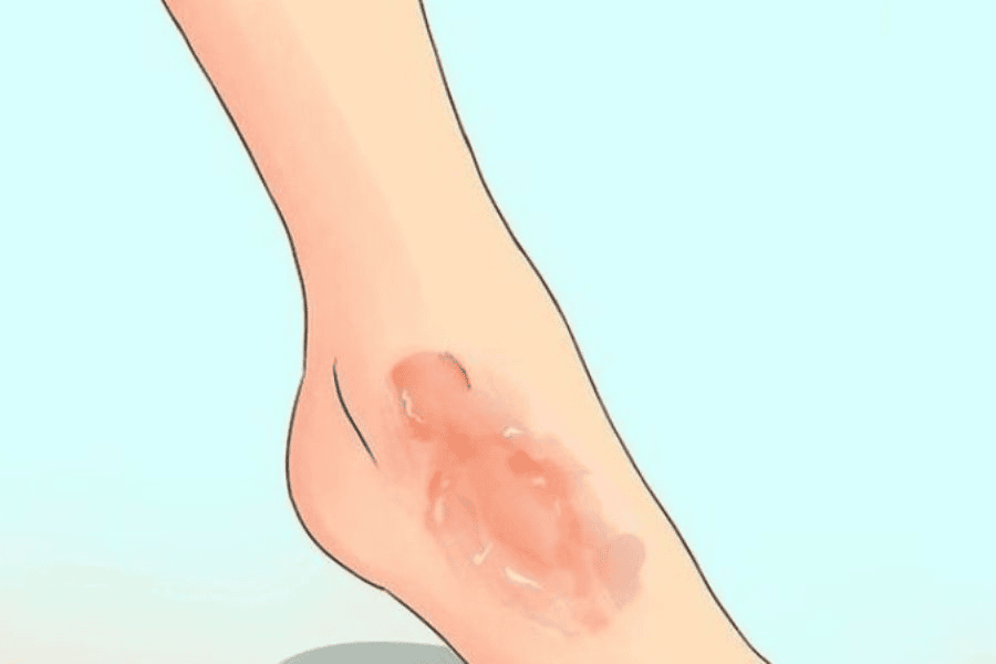 Bỏng cấp độ 1 chỉ ảnh hưởng đến lớp biểu bì bên ngoài của da