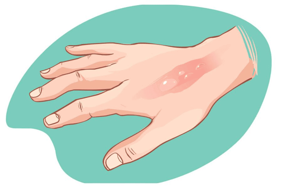 Bỏng cấp độ 3 là mức độ nghiêm trọng nhất, da bị hoại tử và cứng