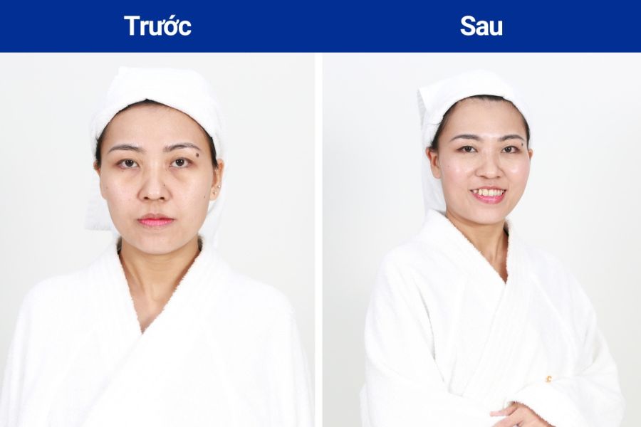 Hình ảnh khách hàng thực hiện trẻ hóa da tại Ngọc Dung beauty