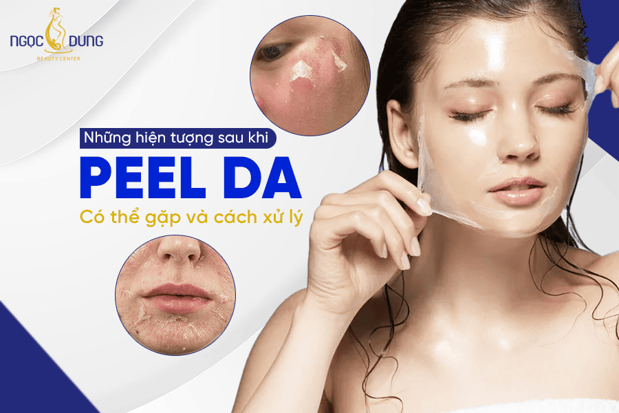 Các hiện tượng sau khi peel da thường gặp