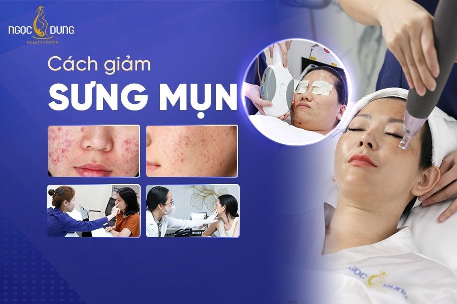 Tips Chăm Sóc Da Hàng Ngày Để Phòng Tránh Mụn