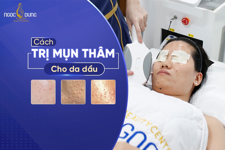 Cách trị mụn thâm cho da dầu