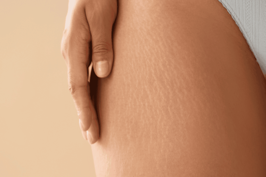 Có thể điều trị rạn da chân tại nhà bằng các nguyên liệu tự nhiên