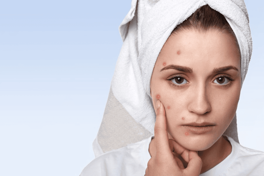 Da bị bỏng rát và rỉ dịch sau khi peel là biến chứng nguy hiểm 