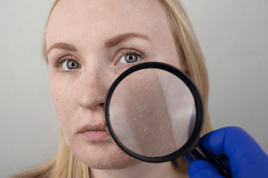 Da mặt sần sùi: Nguyên nhân, dấu hiệu và cách điều trị 3 Da mặt sần sùi do thiếu độ ẩm trầm trọng