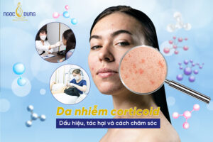 da nhiễm corticoid