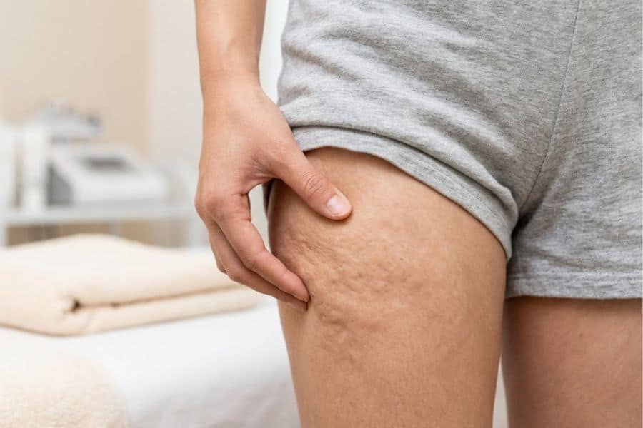 Hiện tượng sần vỏ cam là gì? Nguyên nhân và cách trị 16 Bề mặt da sần vỏ cam có thể rõ hơn khi dùng tay véo hoặc ép nhẹ vùng da bị ảnh hưởng