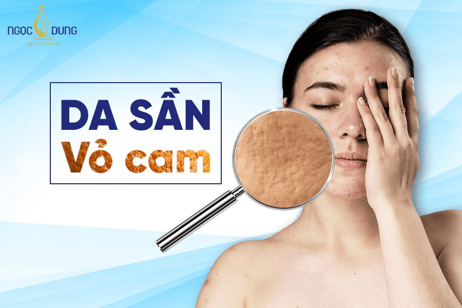 Da sần vỏ cam là gì? Có khó chữa trị không?