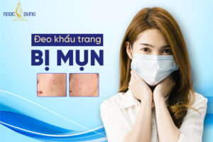 Đeo khẩu trang bị mụn