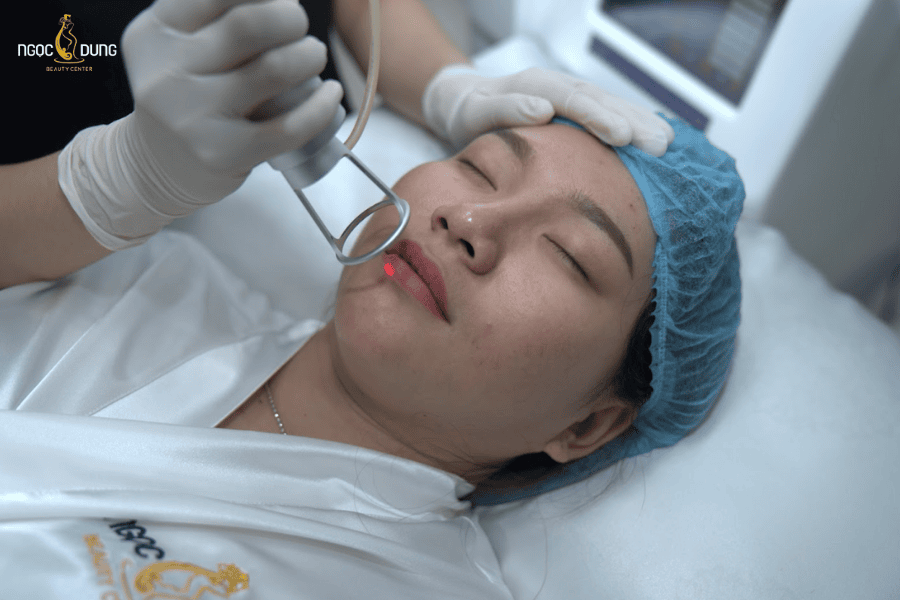Điều trị thâm viền môi bằng công nghệ laser hiện đại tại TMV Ngọc Dung