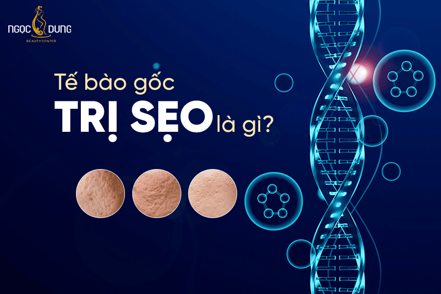 Định nghĩa về trế bào gốc trị sẹo rỗ 