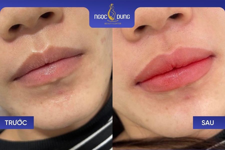 Chị Minh Thư (28 tuổi, TP. HCM) sau khử thâm môi tại Ngọc Dung Beauty