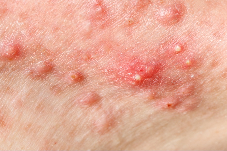 Lá vối chứa chất kháng sinh thực vật có tác dụng sát khuẩn cho mụn viêm và có thể làm liền vết bỏng và ngăn ngừa sẹo trên da
