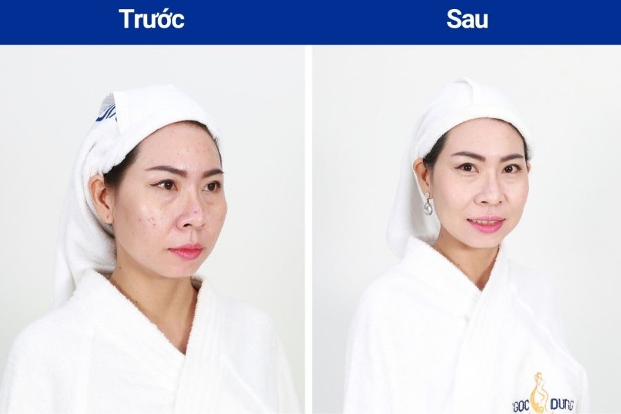Hình ảnh khách hàng trước và sau khi điều trị mụn tại Ngọc Dung beauty